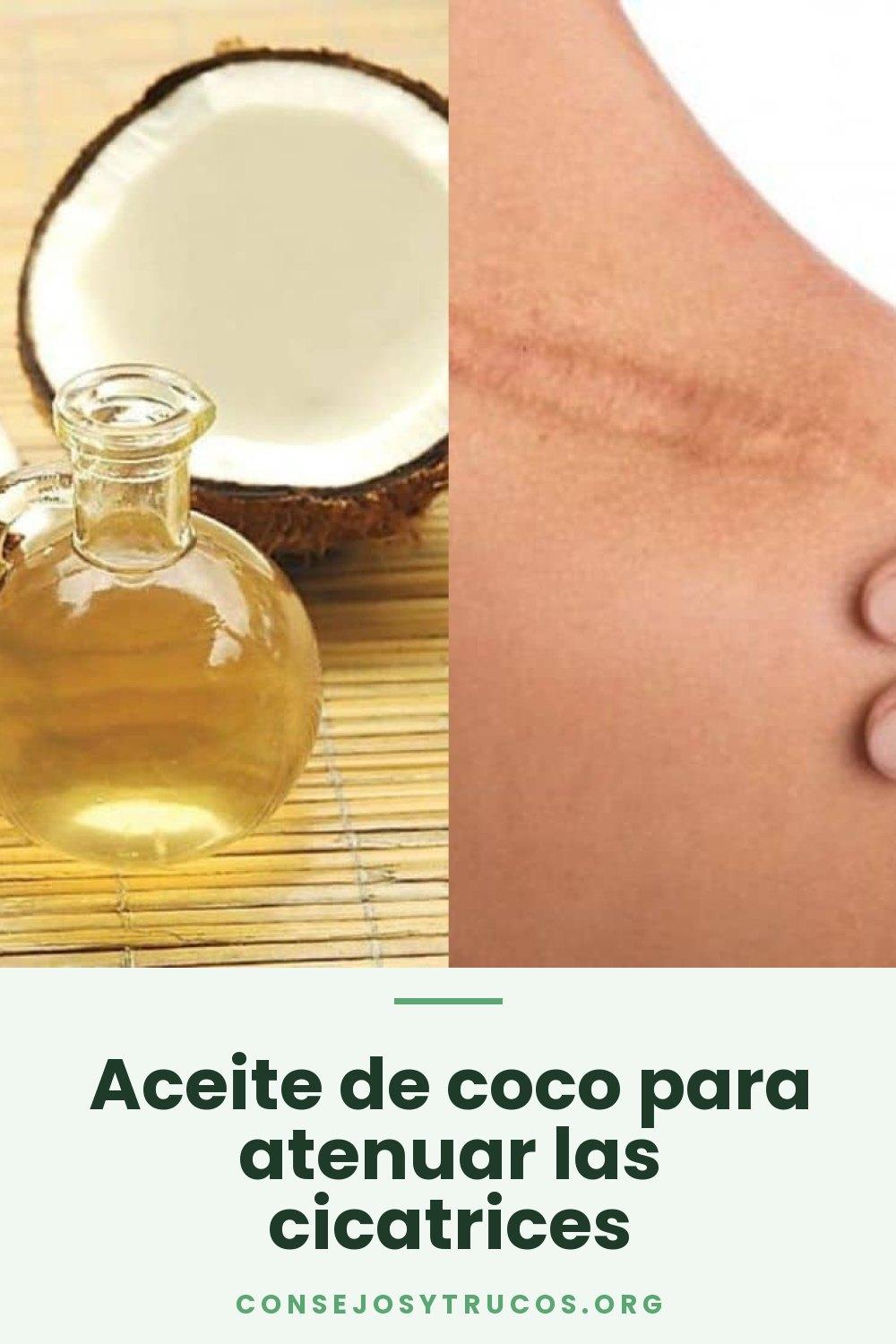Aceite de coco para atenuar las cicatrices