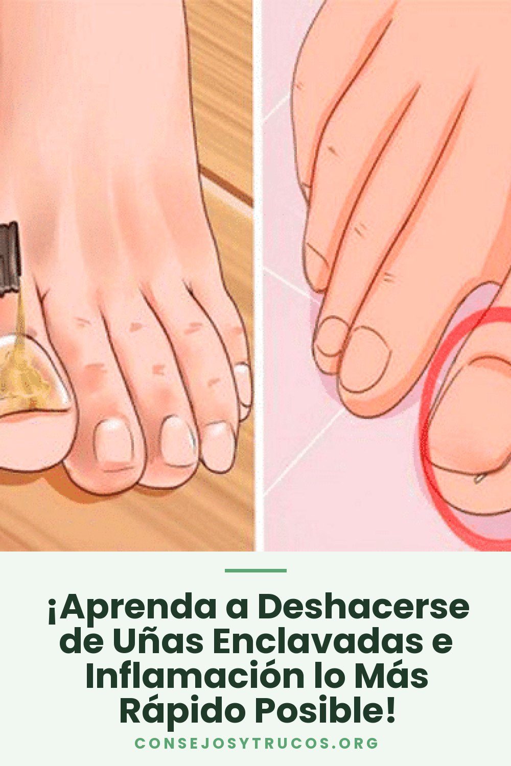 ¡Aprenda a Deshacerse de Uñas Enclavadas e Inflamación lo Más Rápido Posible!