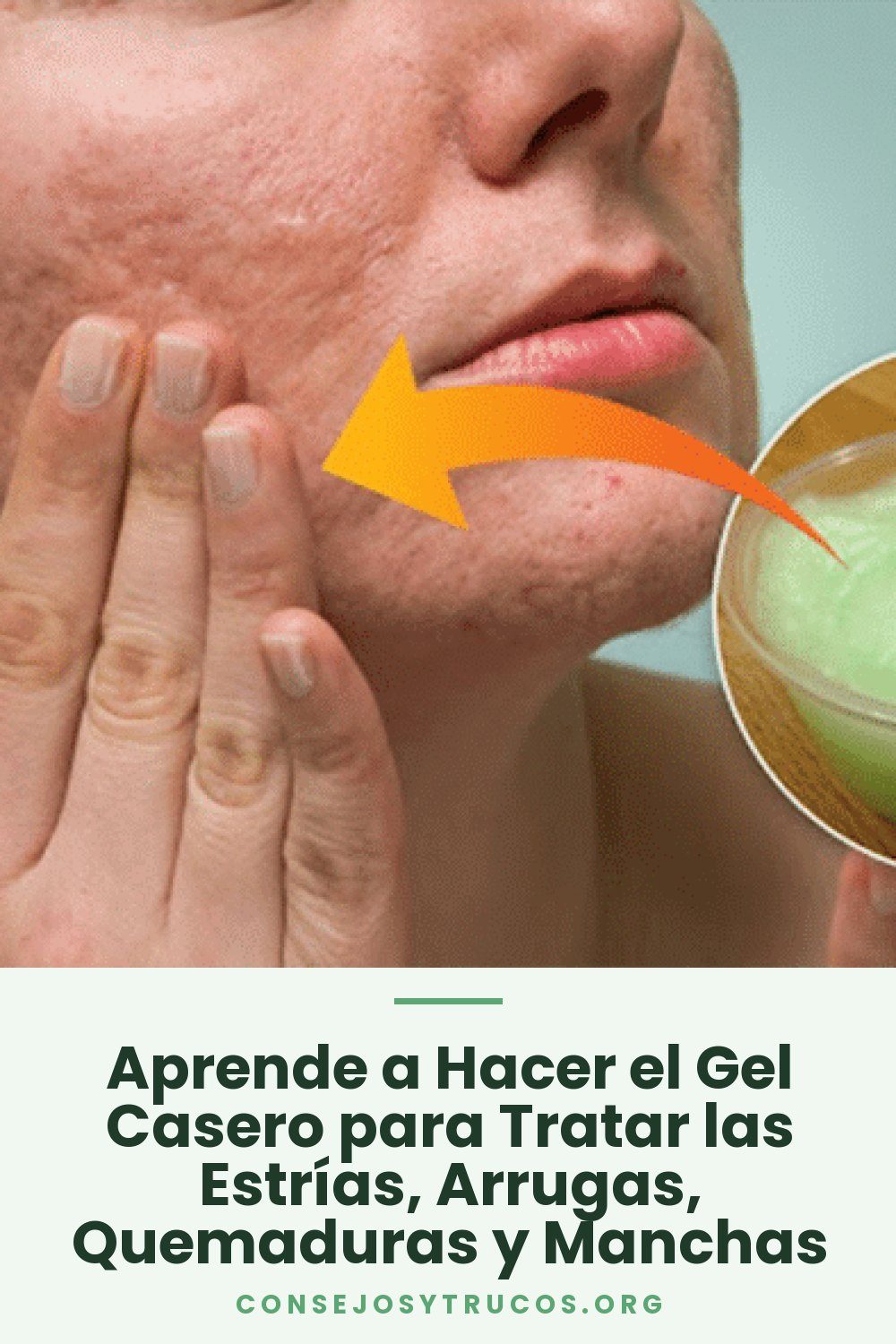 Aprende a Hacer el Gel Casero para Tratar las Estrías, Arrugas, Quemaduras y Manchas