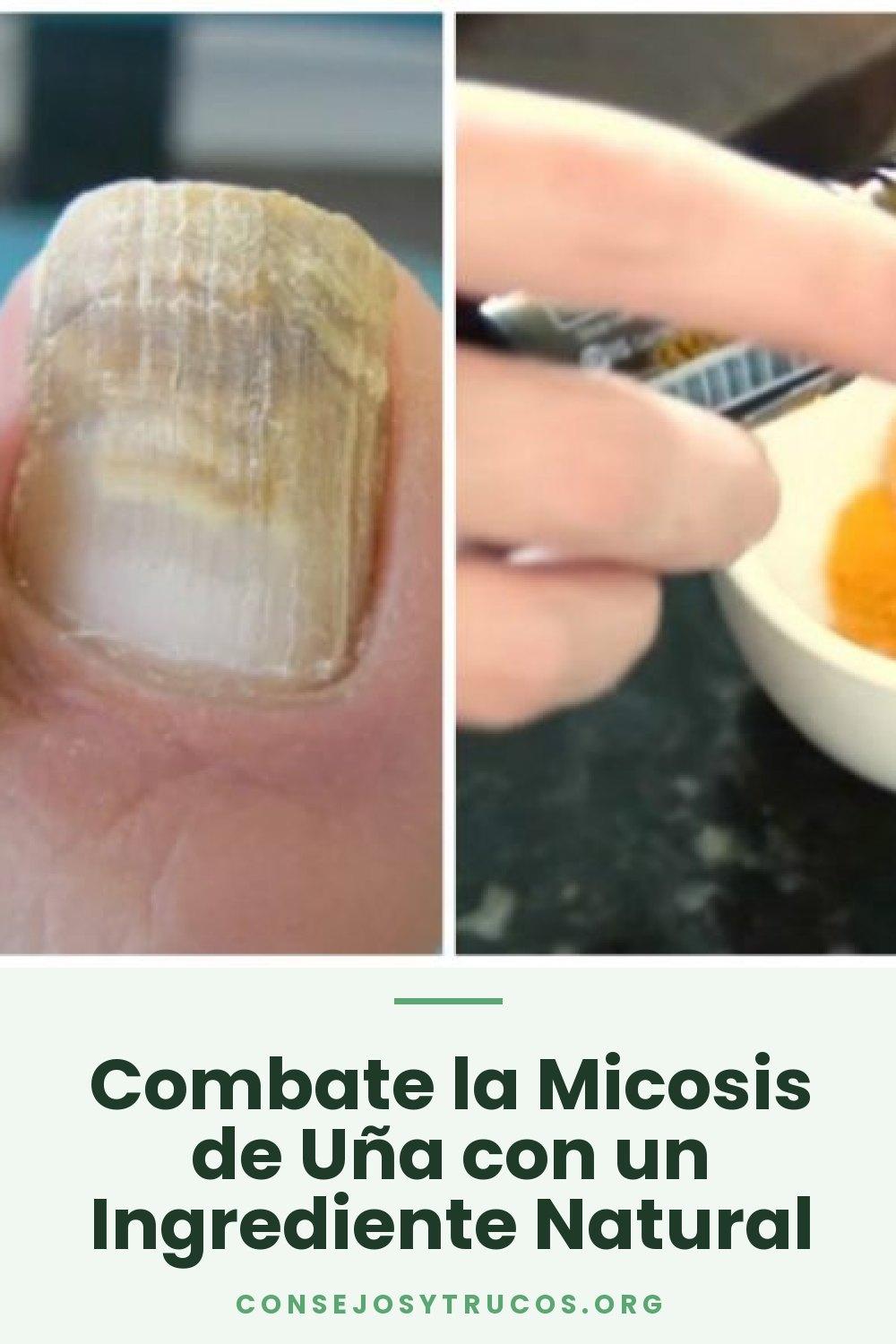 Combate la Micosis de Uña con un Ingrediente Natural