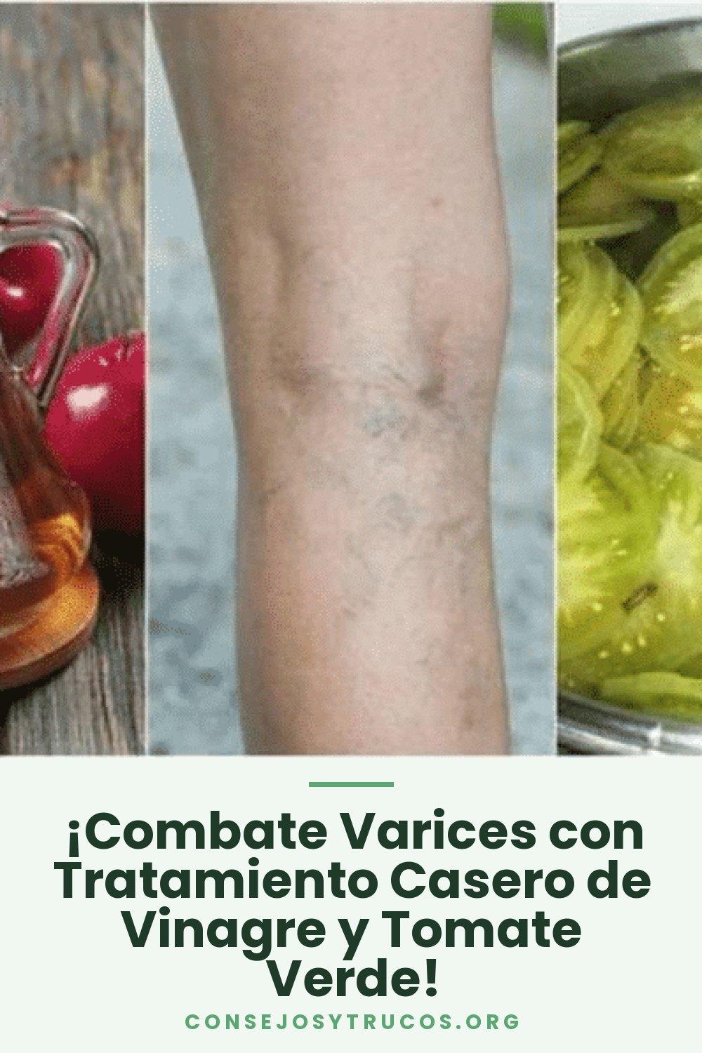 ¡Combate Varices con Tratamiento Casero de Vinagre y Tomate Verde!