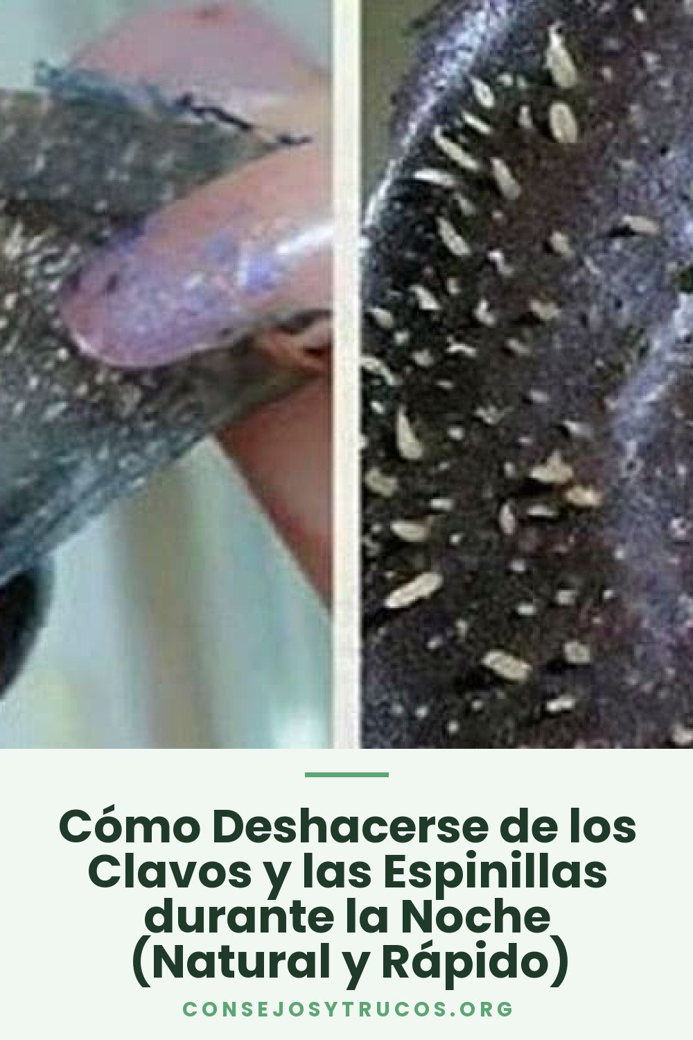 Cómo Deshacerse de los Clavos y las Espinillas durante la Noche (Natural y Rápido)