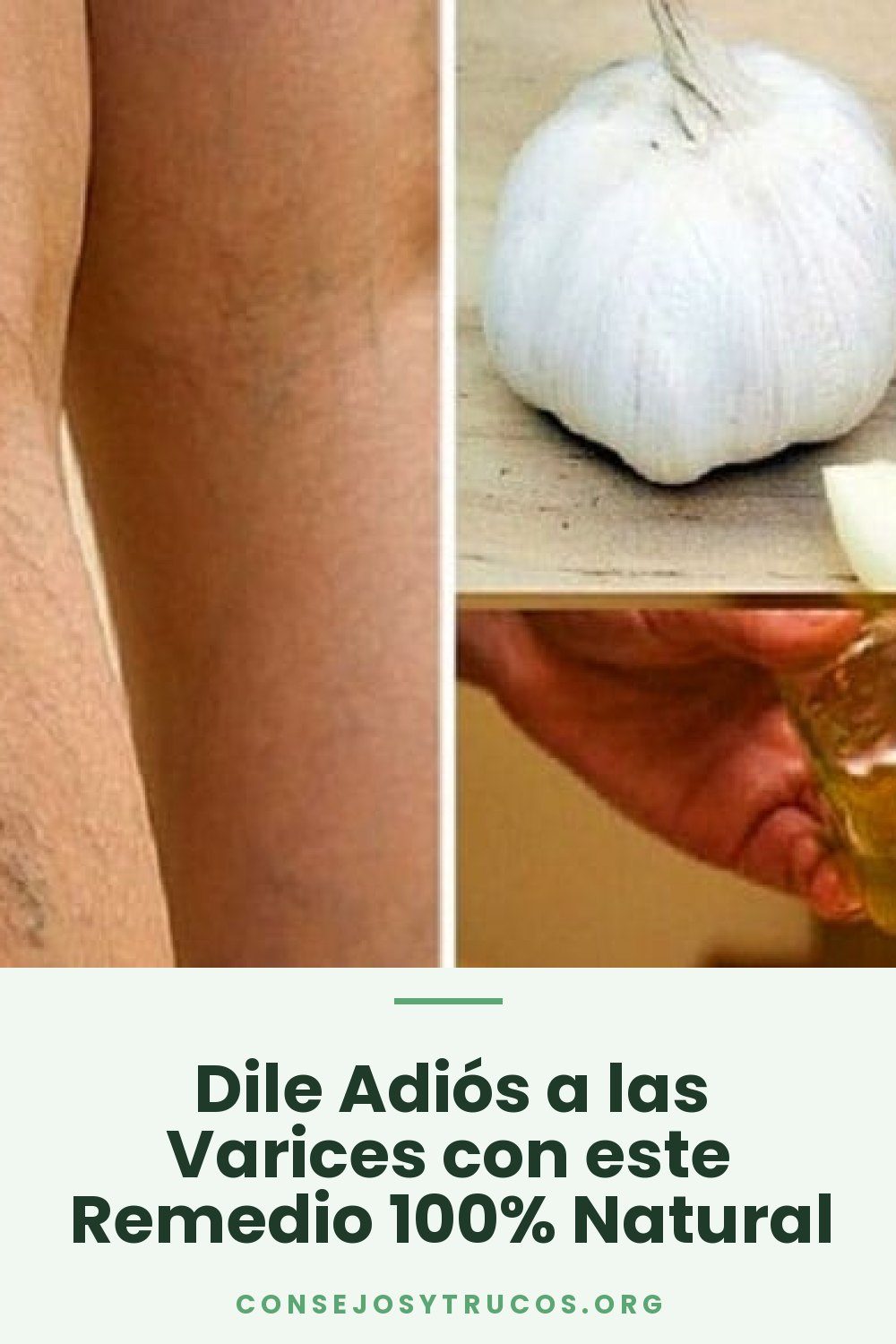Dile Adiós a las Varices con este Remedio 100% Natural