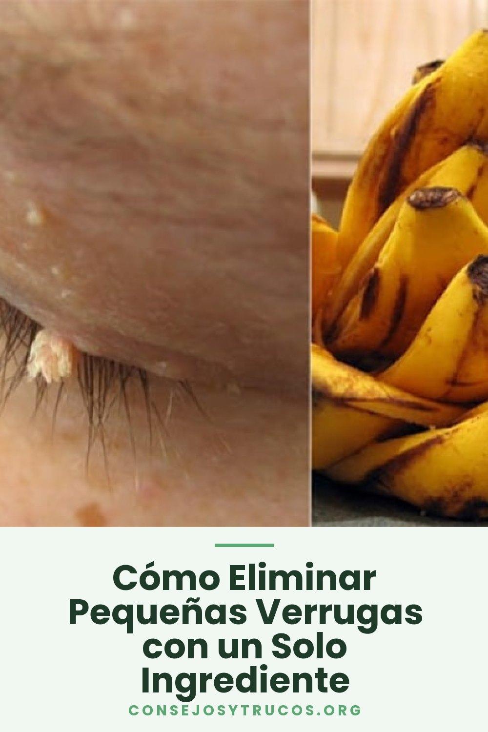 Cómo Eliminar Pequeñas Verrugas con un Solo Ingrediente