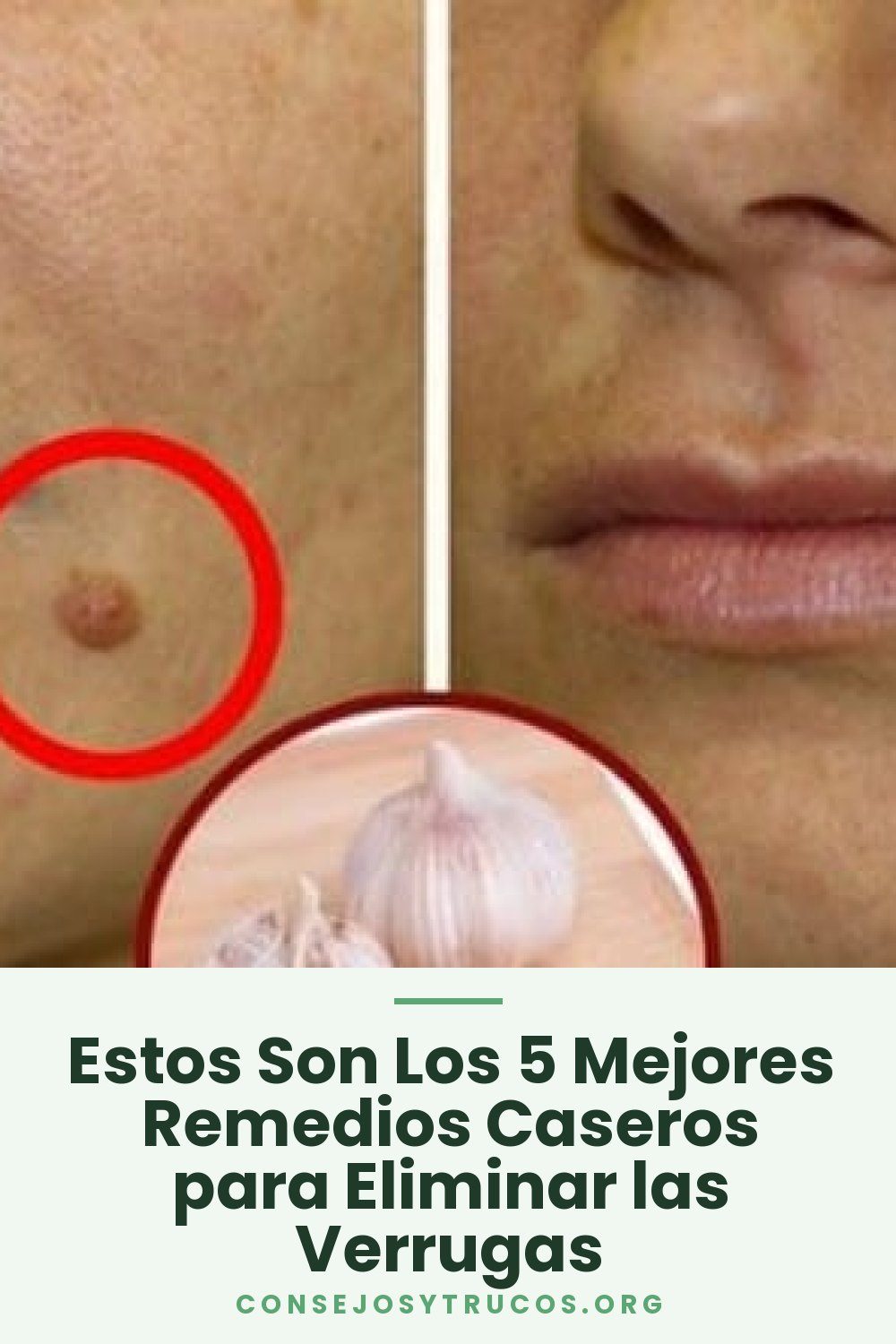 Estos Son Los 5 Mejores Remedios Caseros para Eliminar las Verrugas