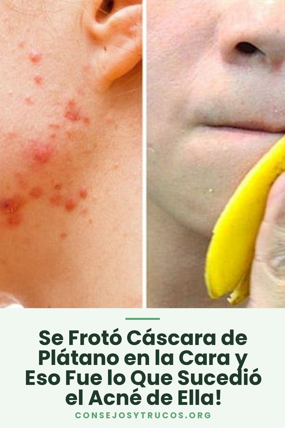 Se Frotó Cáscara de Plátano en la Cara y Eso Fue lo Que Sucedió el Acné de Ella!