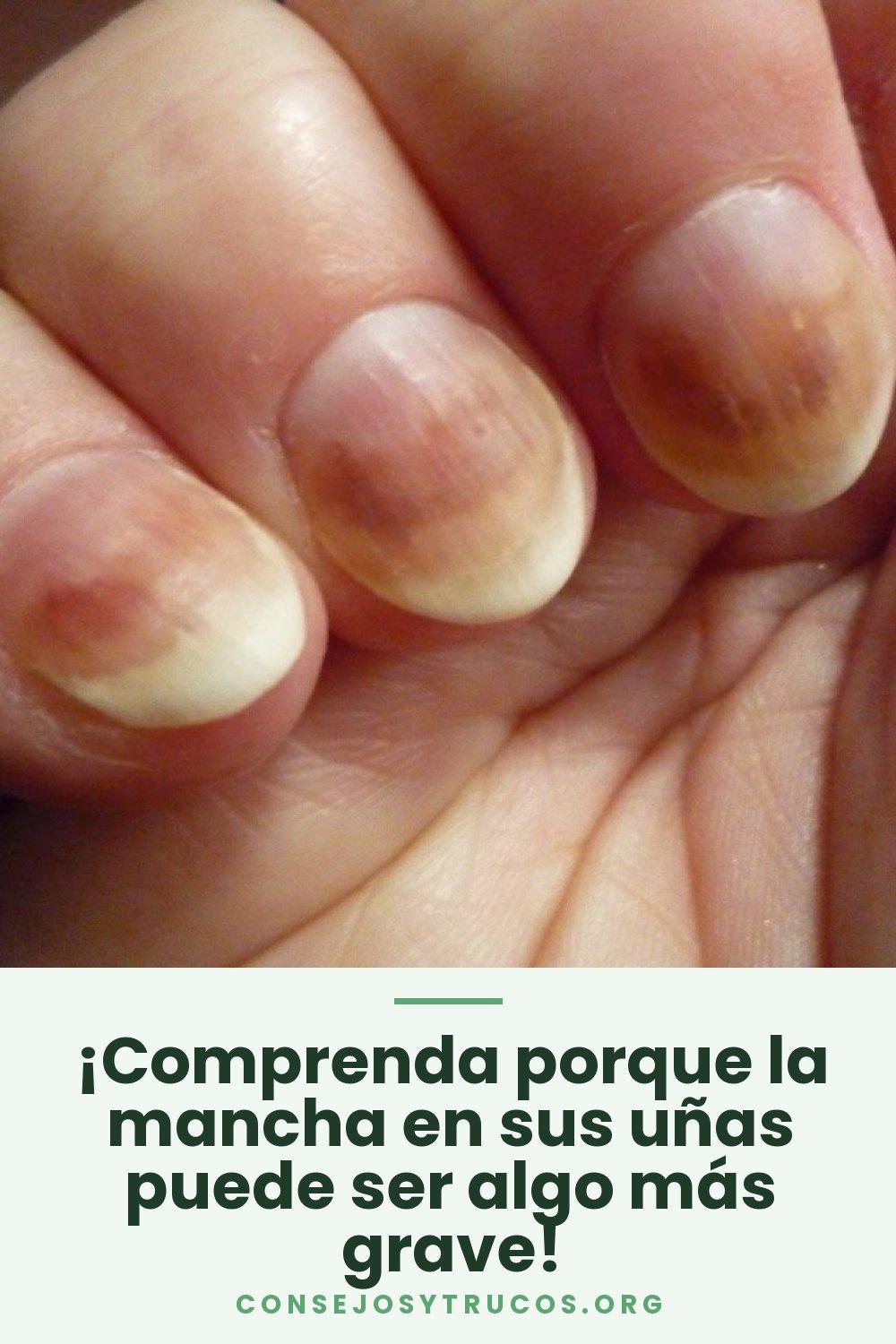 ¡Comprenda porque la mancha en sus uñas puede ser algo más grave!