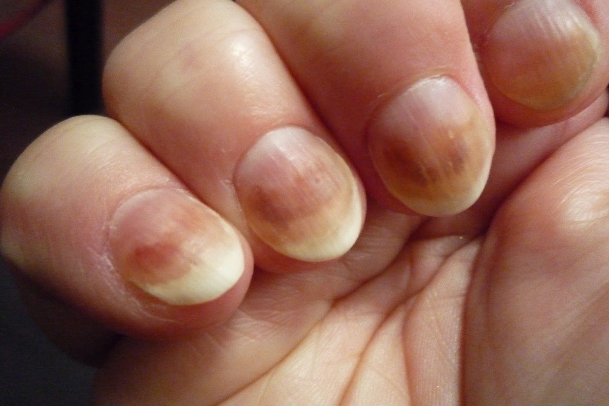 7. Purple Nail Beds: Causes and Treatment for Discolored Nails - wide 2