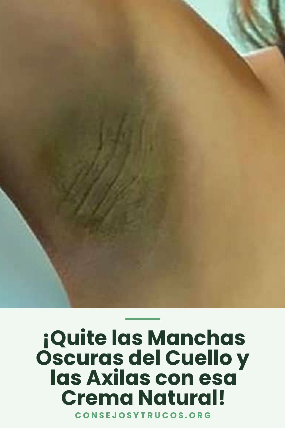 ¡Quite las Manchas Oscuras del Cuello y las Axilas con esa Crema Natural!