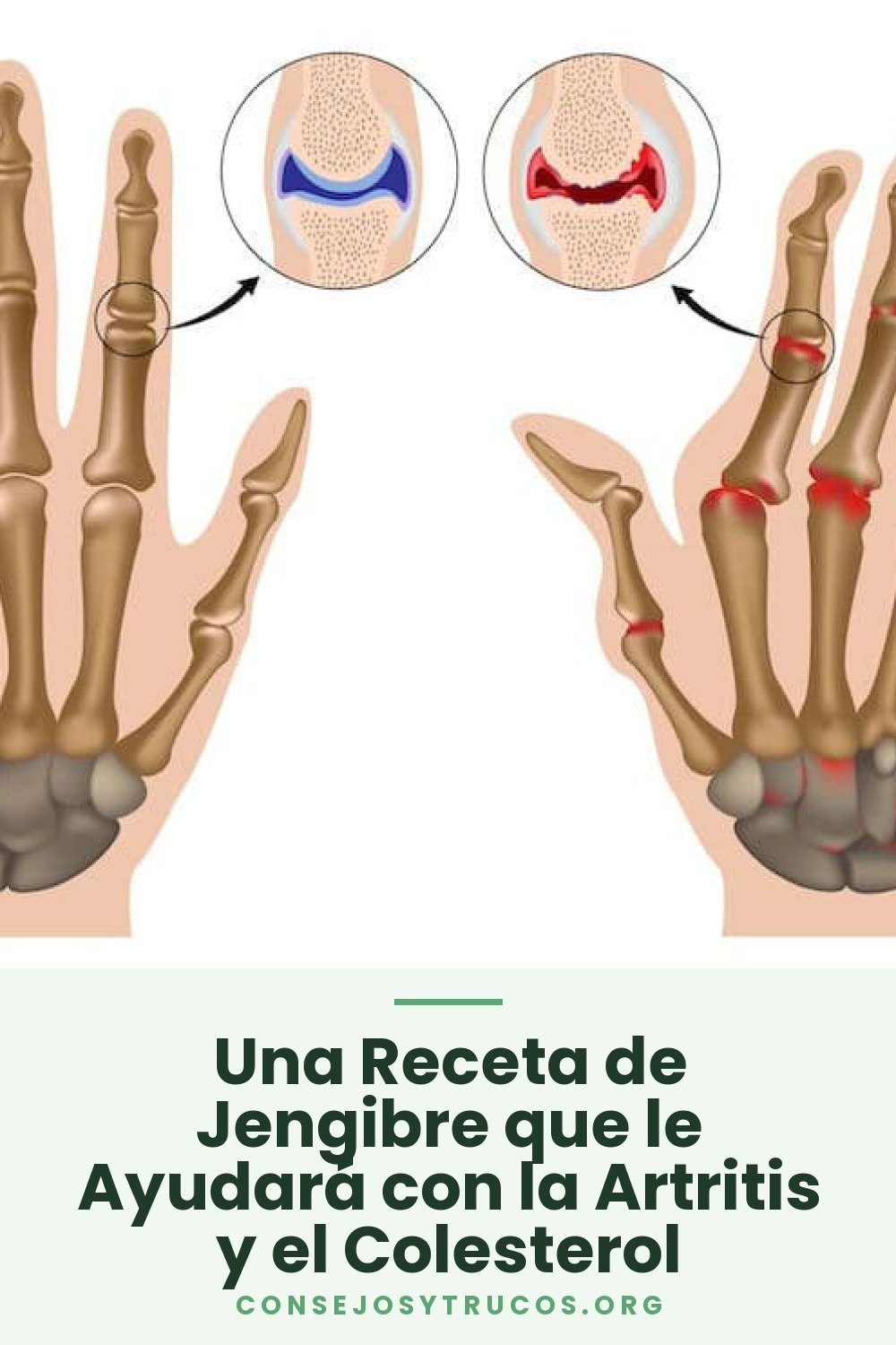 Una Receta de Jengibre que le Ayudará con la Artritis y el Colesterol