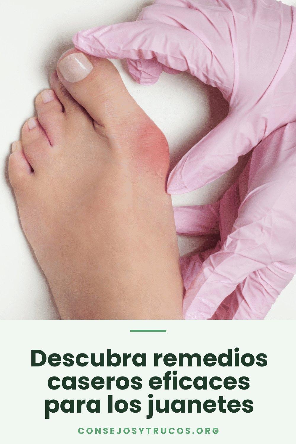 Descubra remedios caseros eficaces para los juanetes