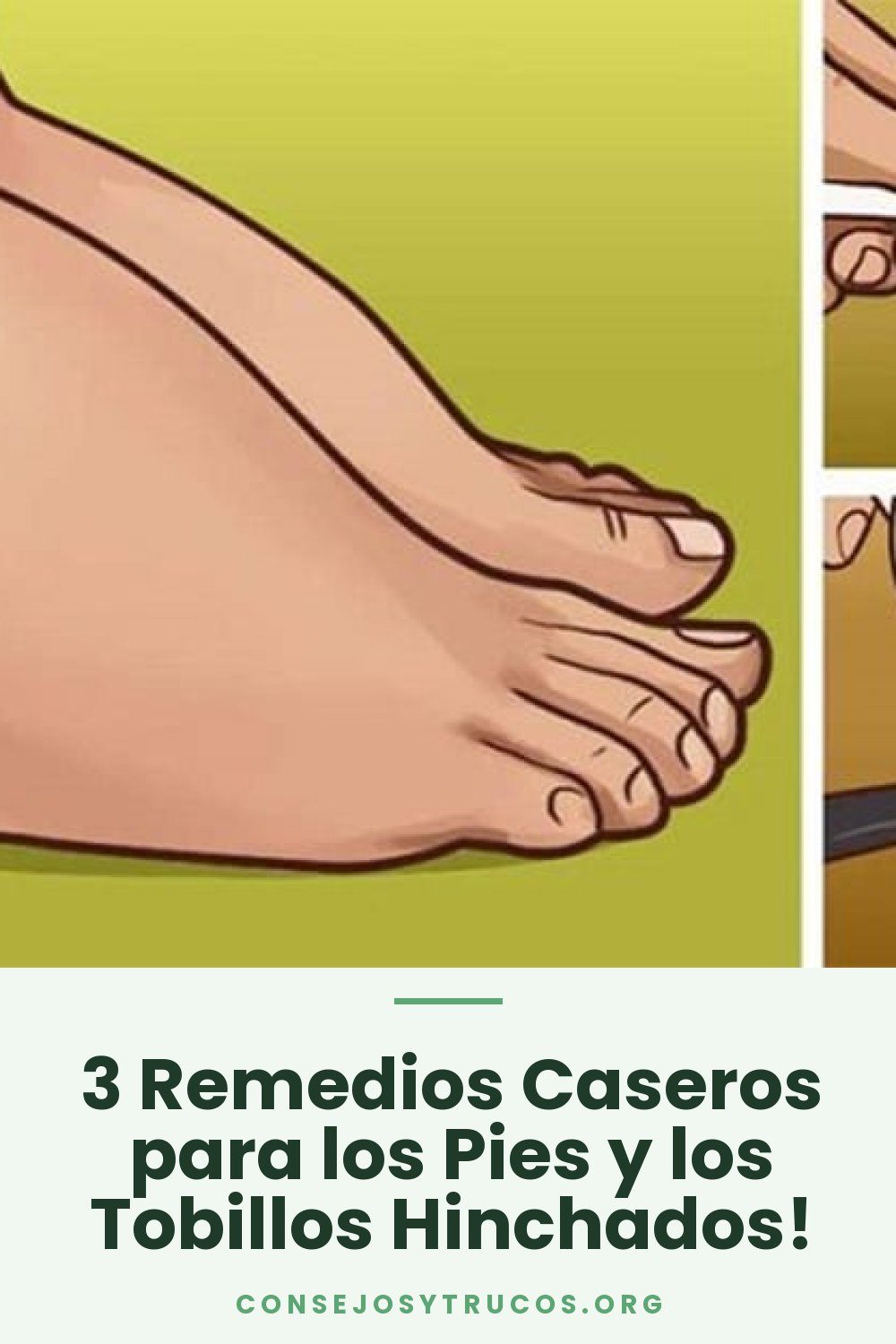 3 Remedios Caseros para los Pies y los Tobillos Hinchados!