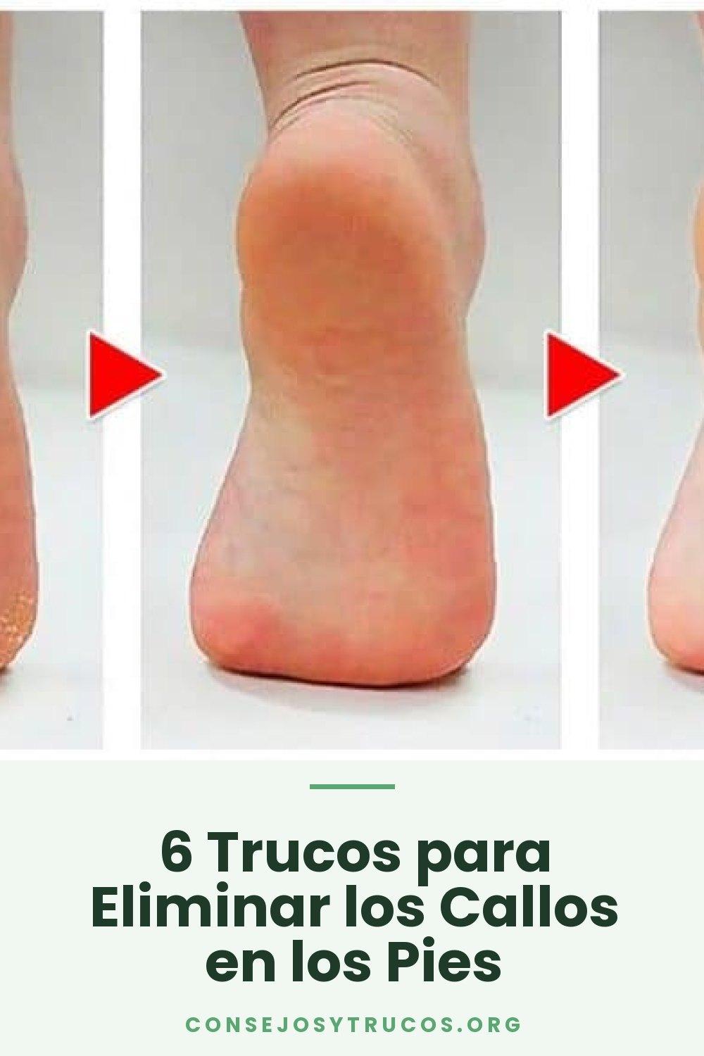 6 Trucos para Eliminar los Callos en los Pies